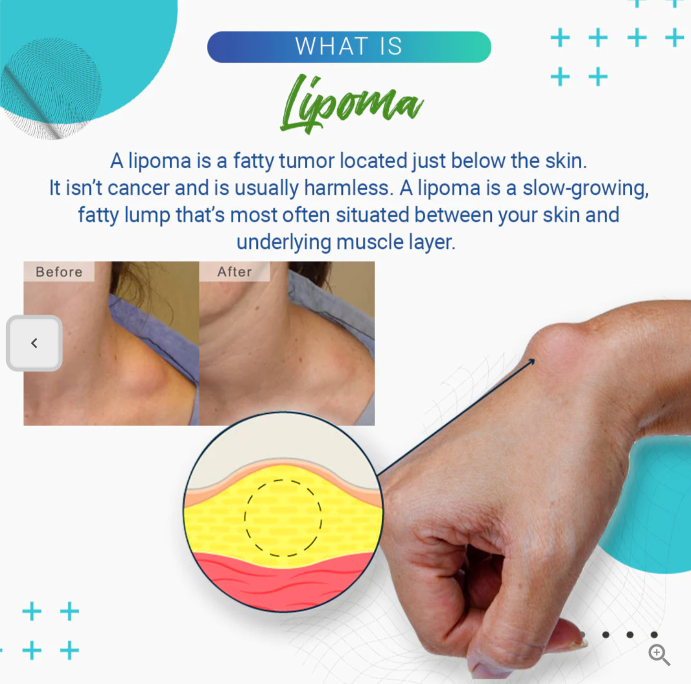 LumpFree™ Lipoma Removal Cream