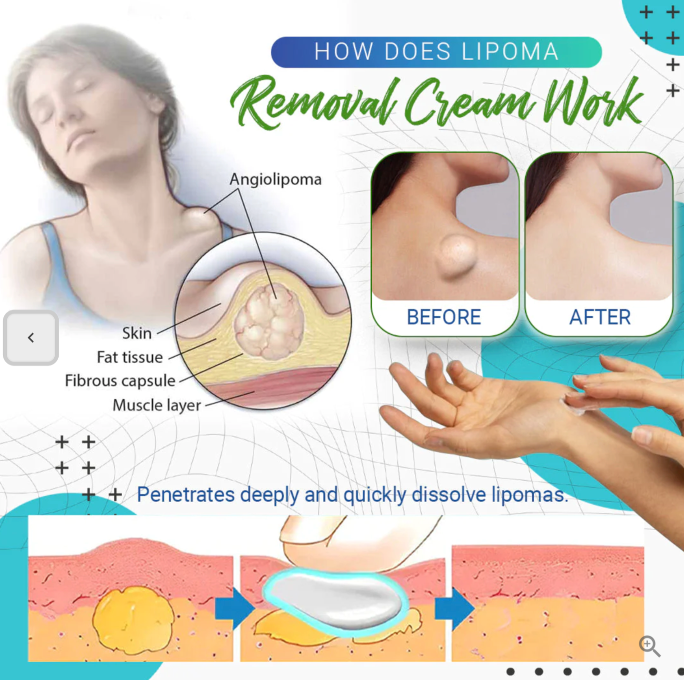 LumpFree™ Lipoma Removal Cream